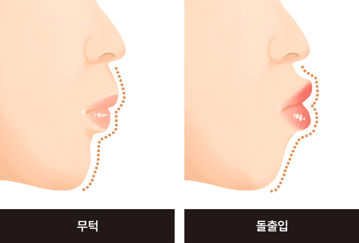 무턱 / 돌출입